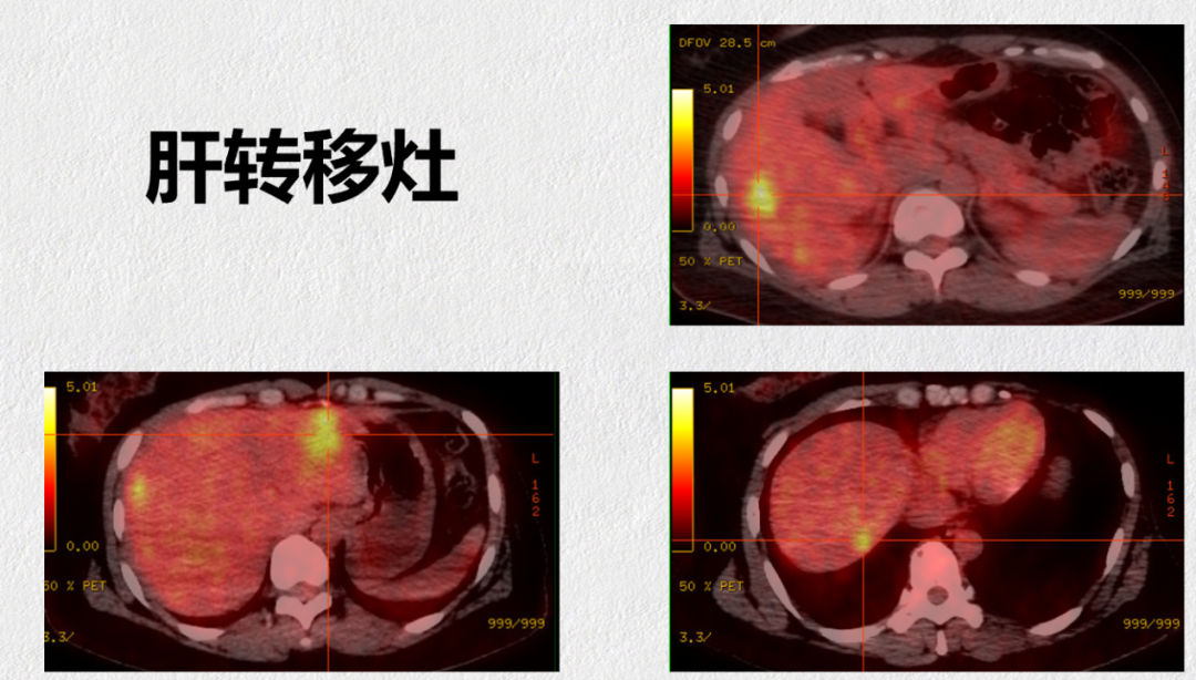 乳腺cr是什么【CDK4／6i学院】超长获益！内分泌耐药、肝及骨转移的绝经前HR+MBC，一线使用哌柏西利，疗效近CR，PFS超32个月医药新闻_https://www.jmylbn.com_新闻资讯_第3张