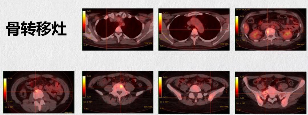 乳腺cr是什么【CDK4／6i学院】超长获益！内分泌耐药、肝及骨转移的绝经前HR+MBC，一线使用哌柏西利，疗效近CR，PFS超32个月医药新闻_https://www.jmylbn.com_新闻资讯_第4张