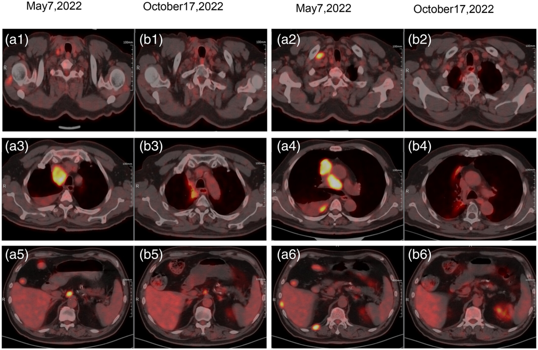 图片[3]-2次50亿个脐血NK输注后，广泛期小细胞肺癌，多发转移缩小、消退！-Hypeptide