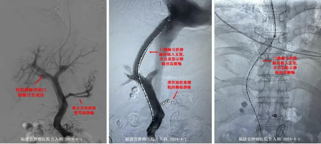 【肿瘤与血管介入科·医疗案例】TIPS让“腹水”不再“难收”医药新闻-ByDrug-一站式医药资源共享中心-医药魔方