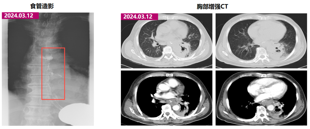 一例食管癌合并食管瘘患者综合治疗案例：全程免疫营养支持联合放化疗助力瘘愈合医药新闻-ByDrug-一站式医药资源共享中心-医药魔方