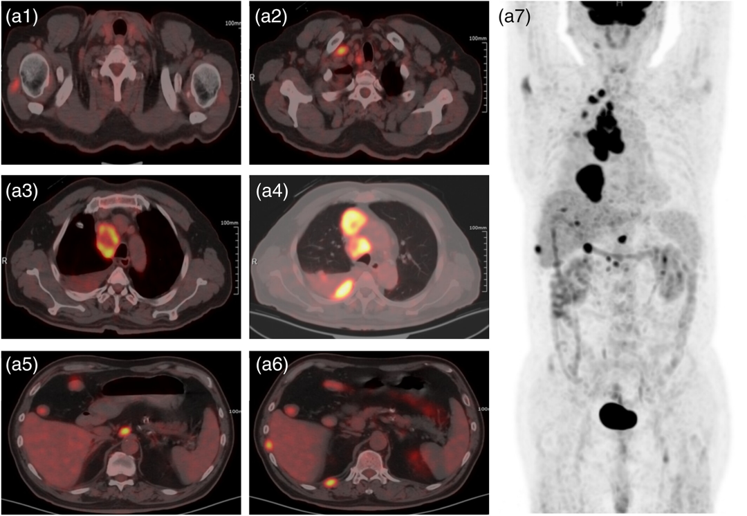 图片[2]-2次50亿个脐血NK输注后，广泛期小细胞肺癌，多发转移缩小、消退！-Hypeptide
