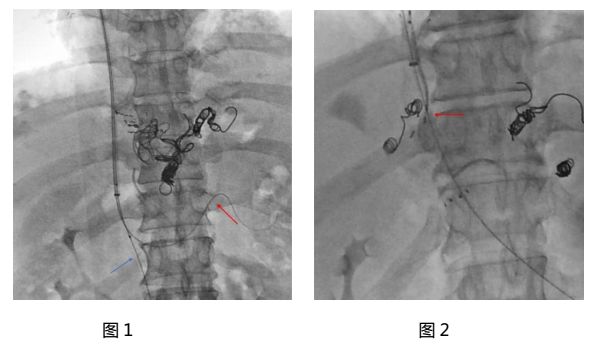 APASL热点丨I-125粒子植入联合TIPS治疗门静脉主干癌栓及其合并症的技术与临床疗医药新闻-ByDrug-一站式医药资源共享中心-医药魔方