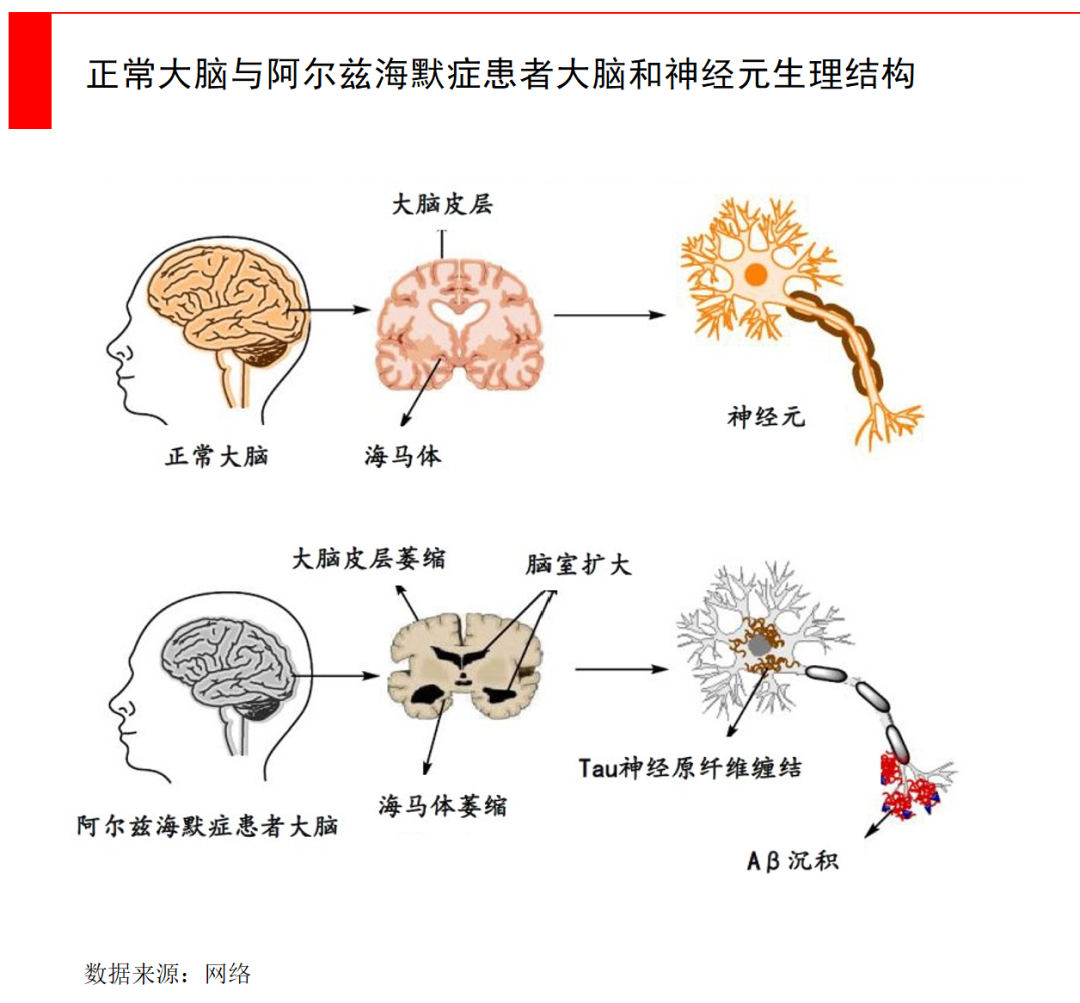 当某些基因出现bug，阿尔兹海默症有哪些新突破？ |【经纬低调研究】医药新闻-ByDrug-一站式医药资源共享中心-医药魔方
