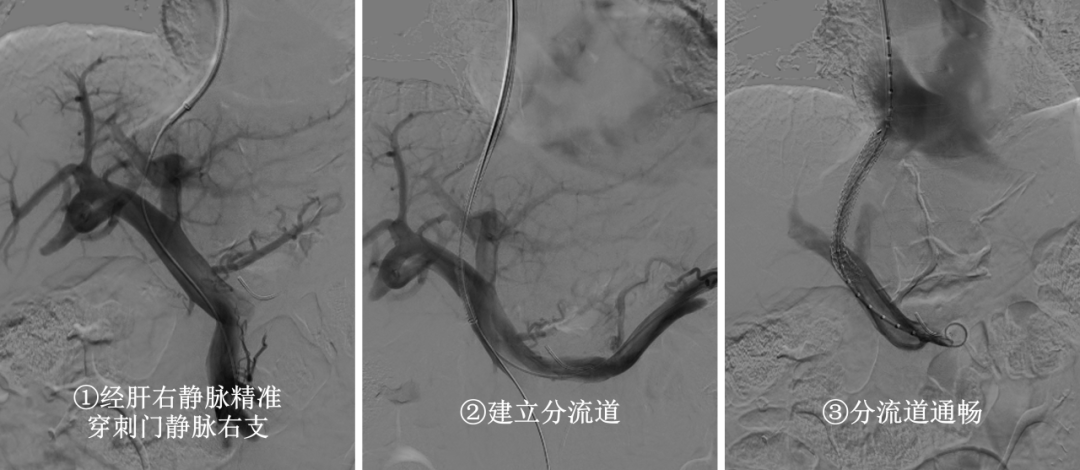 【肿瘤与血管介入微创治疗中心】守护“生命通道”!TIPS手术破解肝硬化出血难题医药新闻-ByDrug-一站式医药资源共享中心-医药魔方